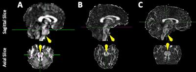 Improving Imaging of the Brainstem and Cerebellum in Autistic Children: Transformation-Based High-Resolution Diffusion MRI (TiDi-Fused) in the Human Brainstem